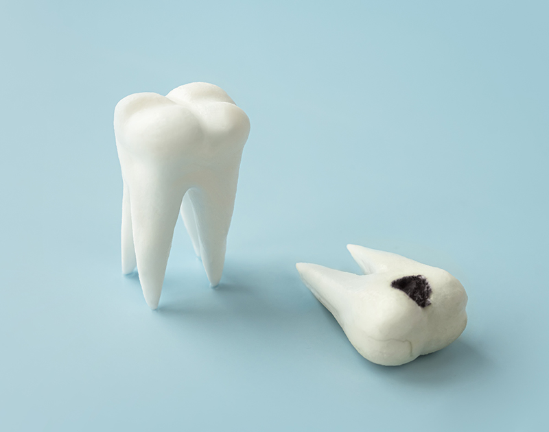 a sick and healthy tooth concept. Teeth with bad sick damaged tooth on blue background. Decay, gum disease. Stomatology, dental problem, poor oral hygiene concept.