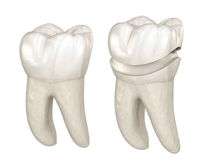 Porcelain crown placement over molar tooth. 3D illustration