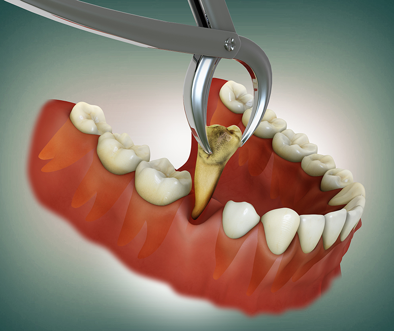 Caries and tooth extraction.