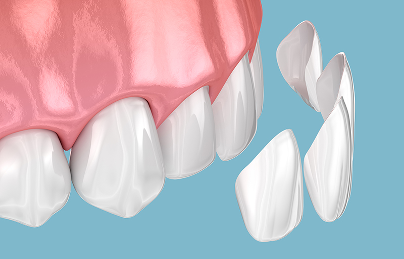 Dental veneer placement over frontal teeth. 3D illustration