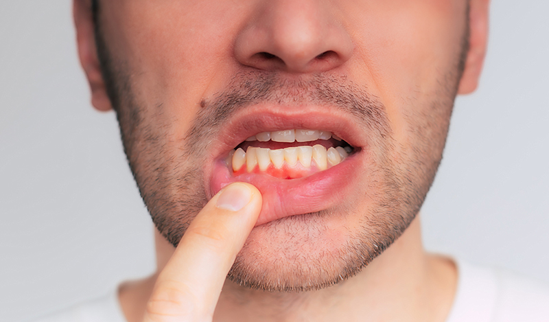 Close up image of gum inflammation. Cropped shot of a young man showing red bleeding gums isolated on a gray background. Dentistry, dental care