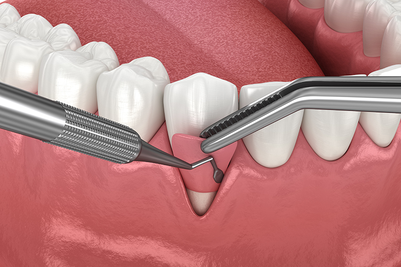 Gingiva Recession: Soft tissue graft surgery. 3D illustration of Dental  treatment