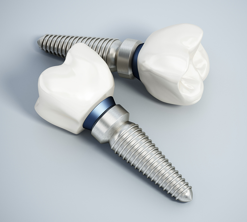 Titanium dental implant models