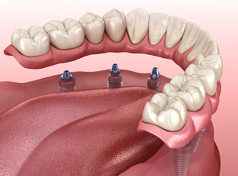 Mandibular prosthesis with gum All on 6 system supported by implants.  Medically accurate 3D illustration of human teeth and dentures concept