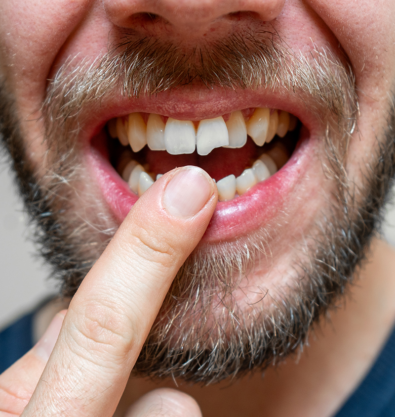 close up of a broken tooth, young adult showing teeh
